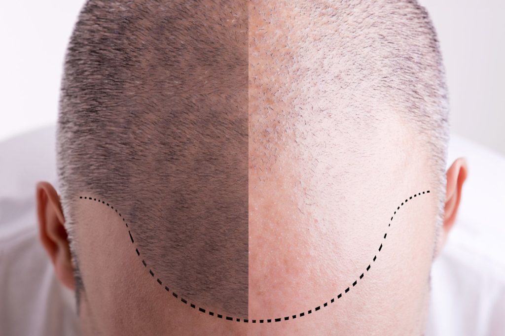 How does a Hair Transplant work?