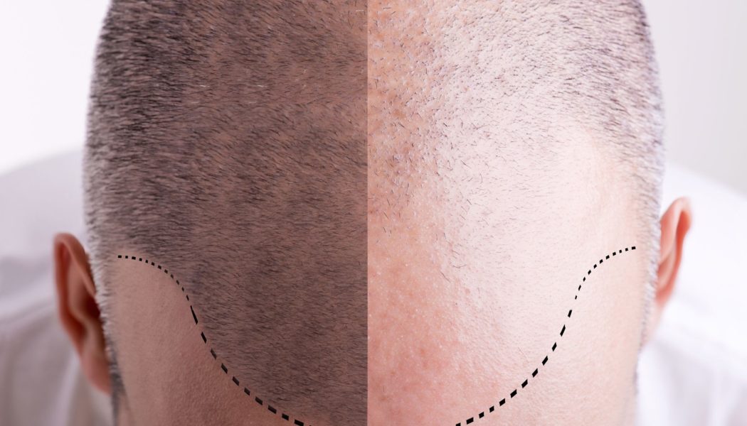 How does a Hair Transplant work?