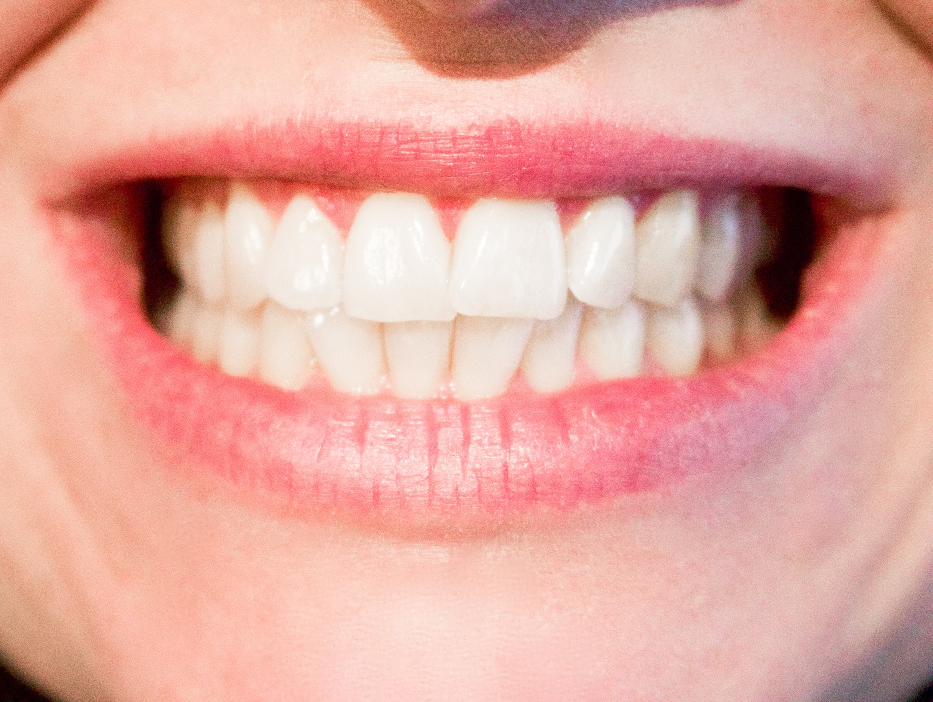 What is so good about Invisalign?