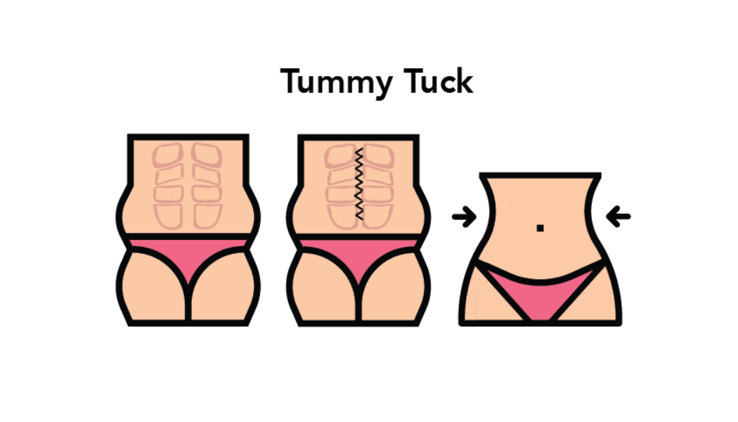 Difference between Tummy Tuck and Liposuction