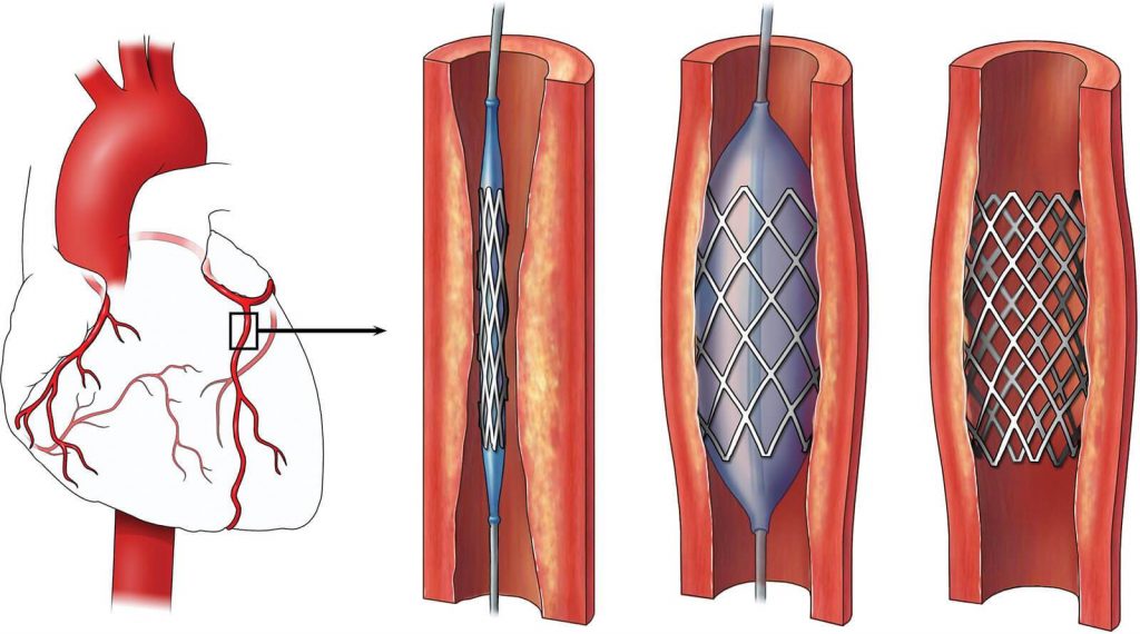 Coronary Angioplasty Procedure Description