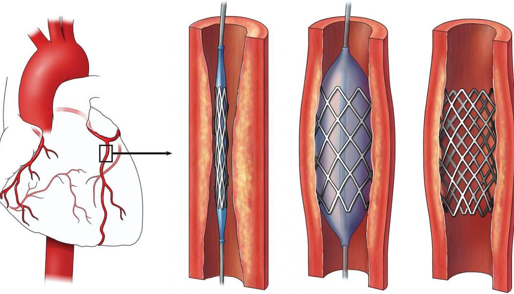 coronary-angioplasty-procedure-description-mymeditravel-knowledge