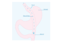 Bariatric Surgery – Not Just a Gastric Bypass