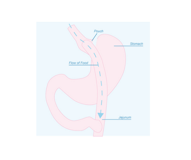 Bariatric Surgery – Not Just a Gastric Bypass