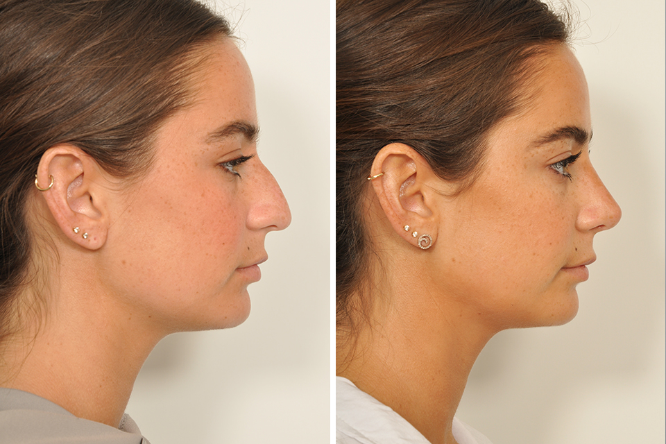 Rhinoplasty Procedure Description Mymeditravel Knowledge 