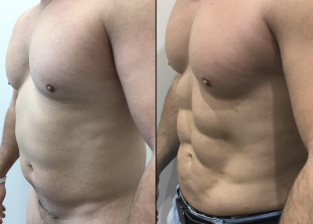 Vaser Liposuction Procedure Description MyMediTravel Knowledge