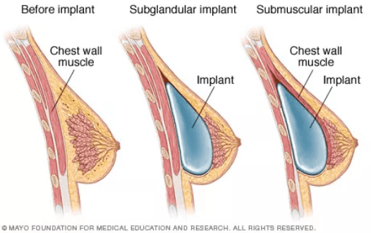 Implant Positioning