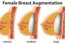 Breast Augmentation Procedure Description
