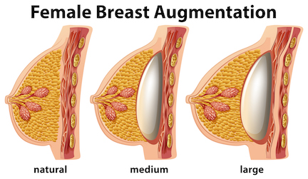 Breast Augmentation Procedure Description