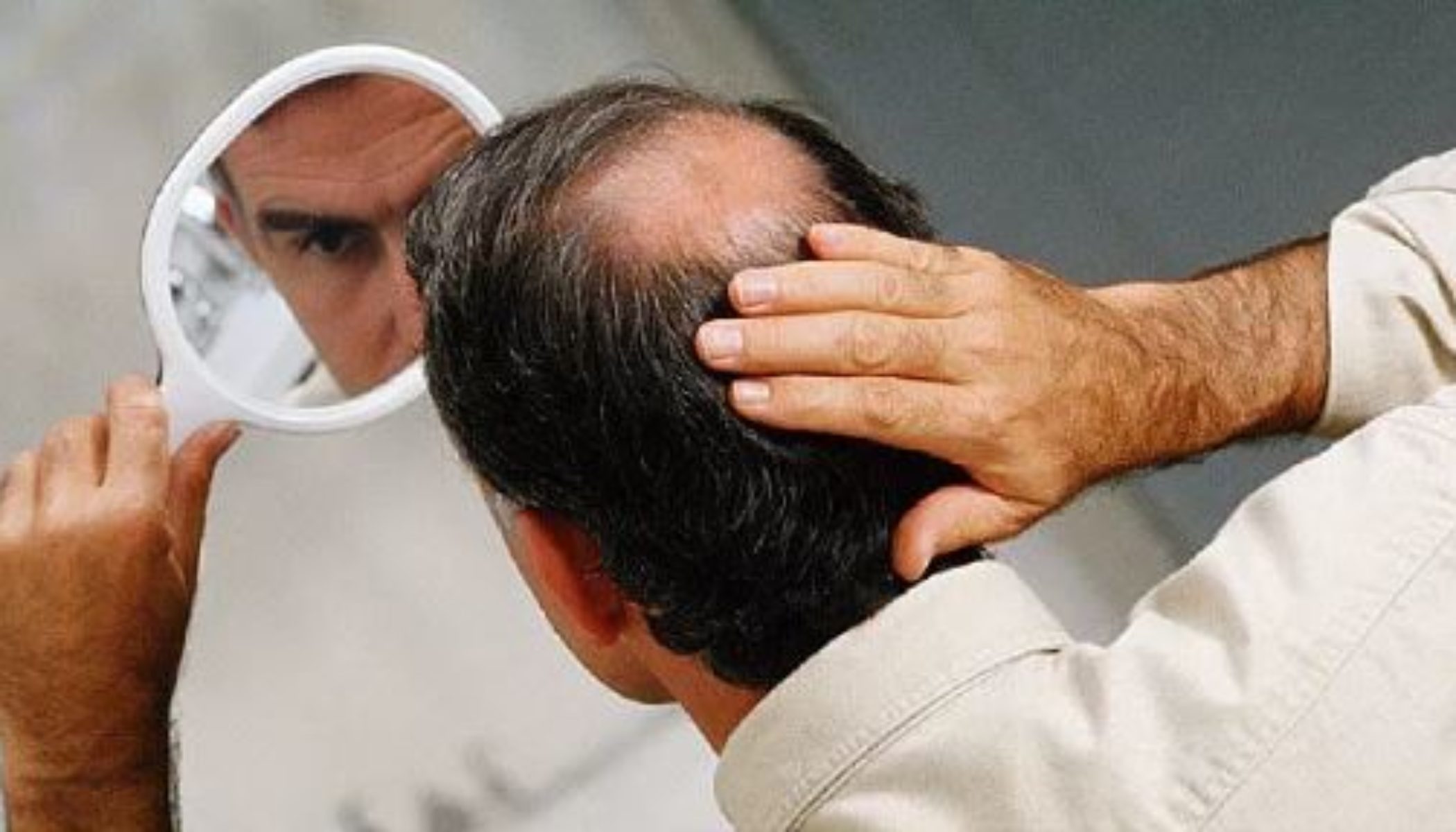 Hair Transplant Procedure Description Mymeditravel Knowledge