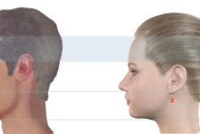 Facial Feminization Surgery (FFS) Procedure Description