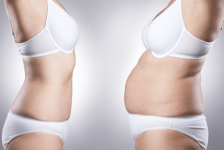 Vaser Liposuction Procedure Description