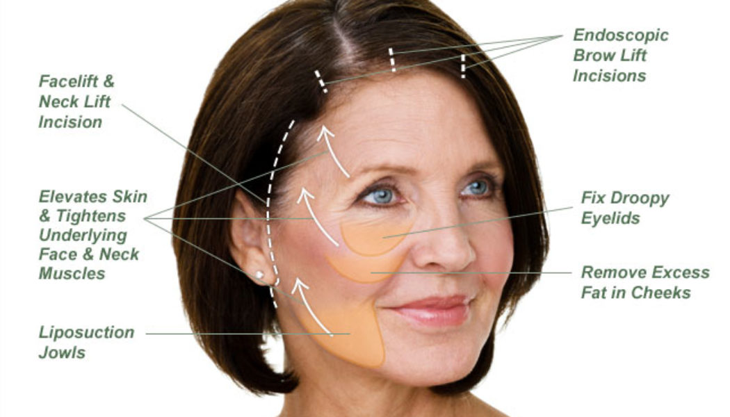 Facelift Procedure Description MyMediTravel Knowledge