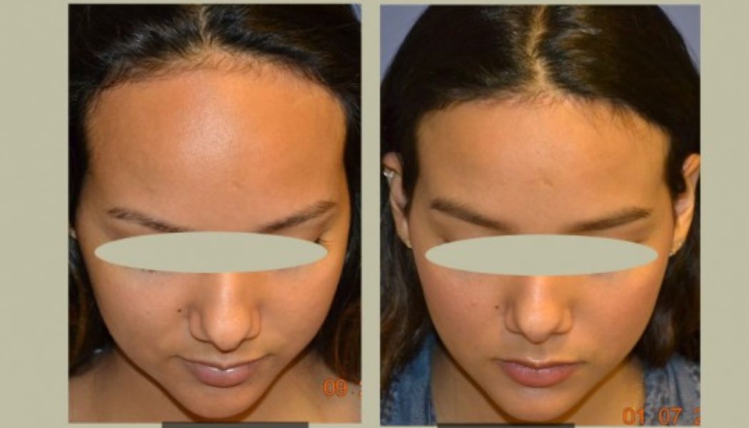Hairline Lowering Surgery Procedure Description
