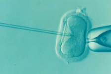 In Vitro Fertilization (IVF) Procedure Description