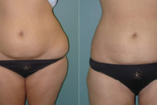 Liposuction Procedure Description