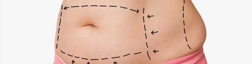 Tummy Tuck Procedure Description Parkway Plastic Surgery