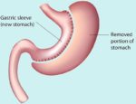 Gastric Sleeve Procedure Description | MyMediTravel Knowledge