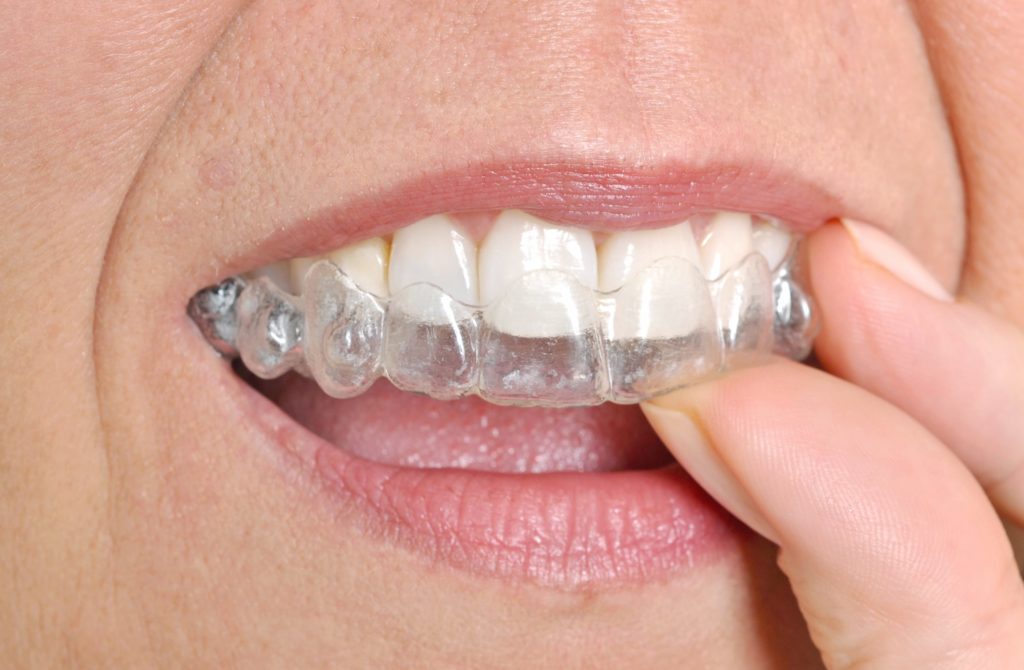 Invisalign Procedure Description