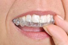 Invisalign Procedure Description