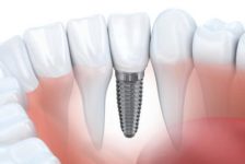 Dental Implants Procedure Description