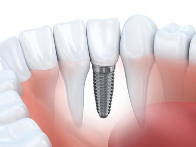Dental Implants Procedure Description