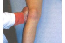 Knee Ligament Surgery (MCL) Procedure Description