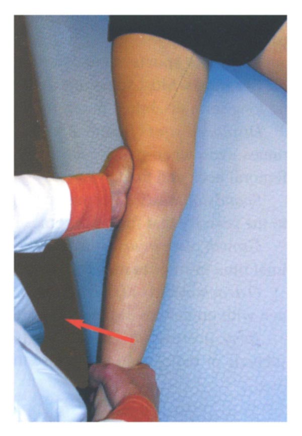 Knee Ligament Surgery (MCL) Procedure Description