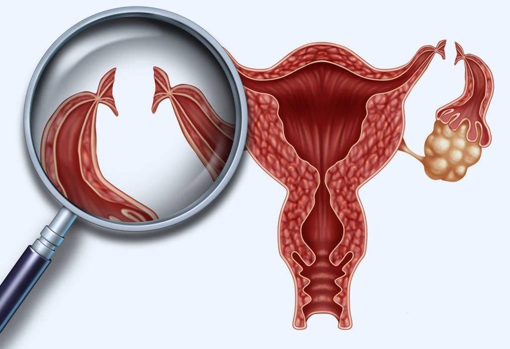Tubal Ligation Reversal Procedure Description