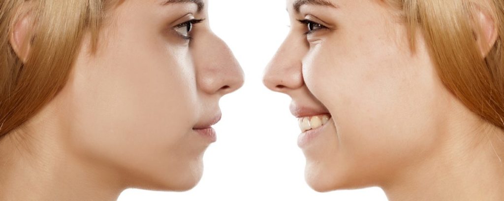 Nose Surgery Procedure Description