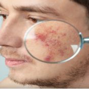 Skin Cancer Surgery Procedure Description