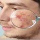 Skin Cancer Surgery Procedure Description