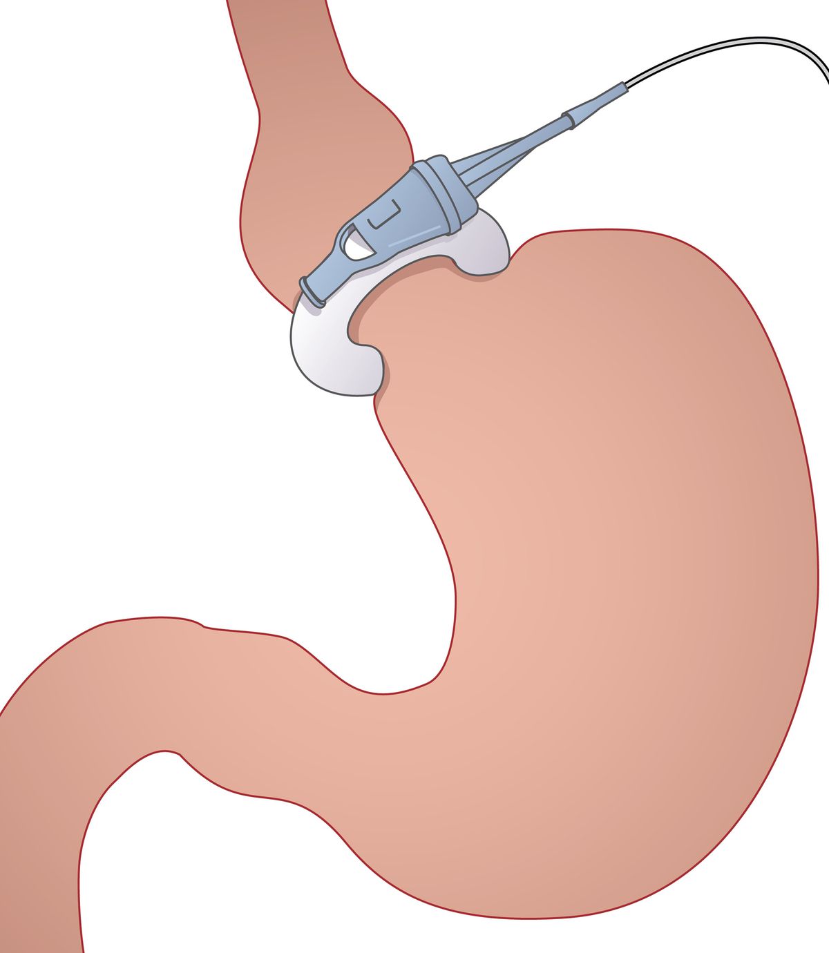 Top 4 Types of Gastric Treatments in Thailand