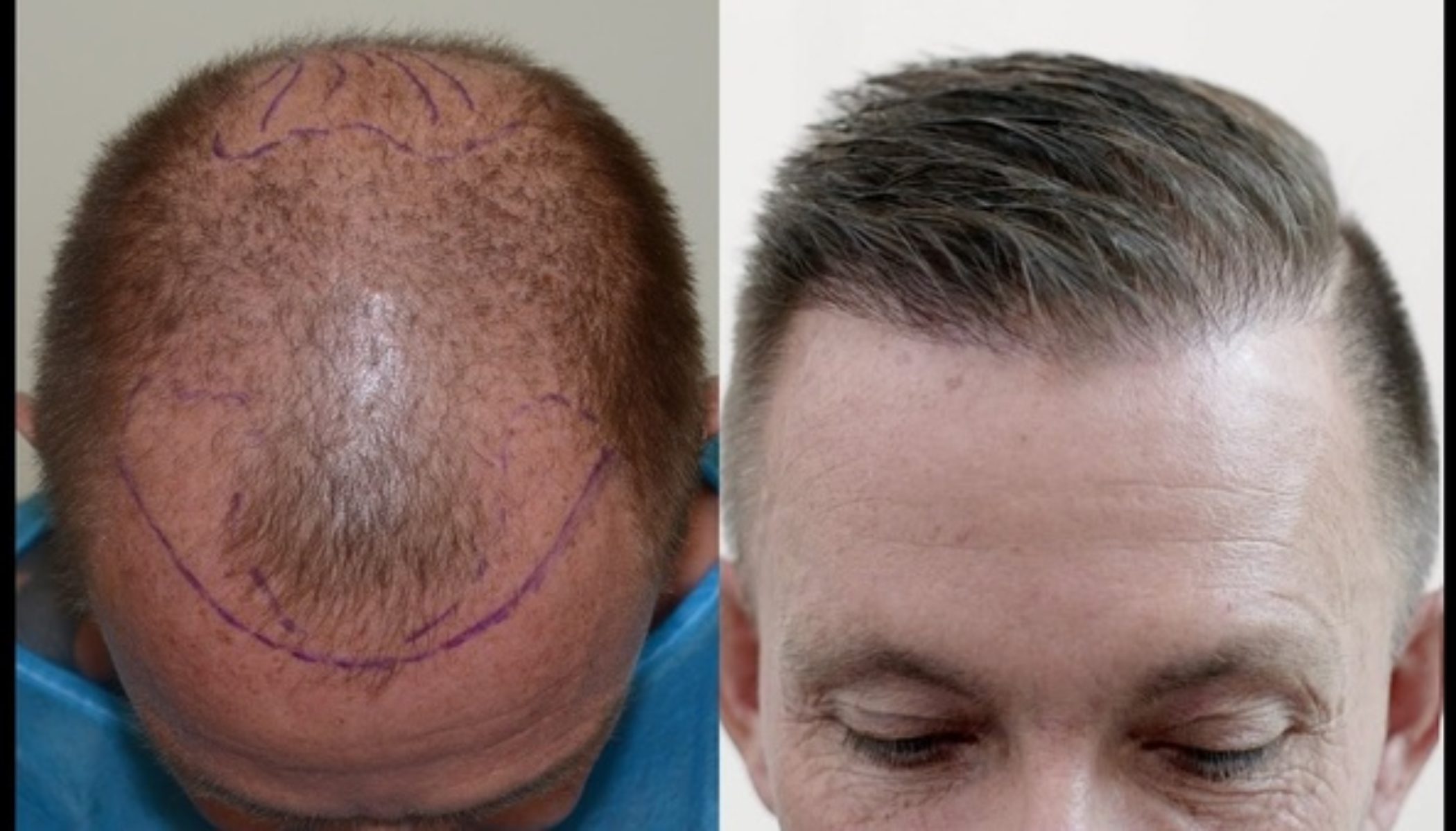 Top Ten Do's and Don'ts Before a Hair Transplant in Bangkok MyMediTravel Knowledge