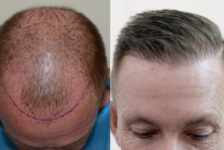 Top Ten Do’s and Don’ts Before a Hair Transplant in Bangkok
