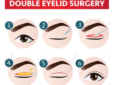 2020 Top Reasons Why You Would Have Double Eyelid Surgery in Thailand
