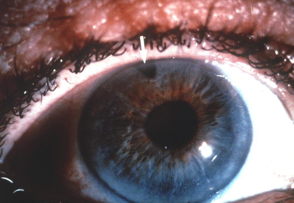 2020 Top Facts About Having a Irdectomy and What is the Purpose of Iridectomy