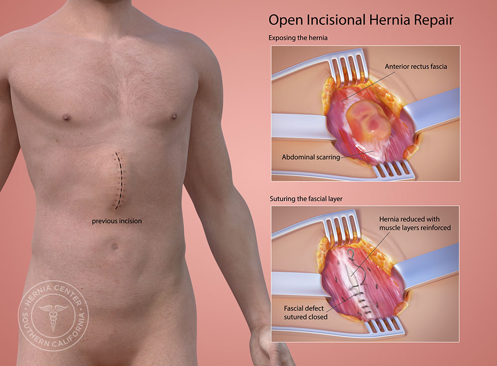 Incisional Hernia Repair Procedure Description Mymeditravel Knowledge 9263