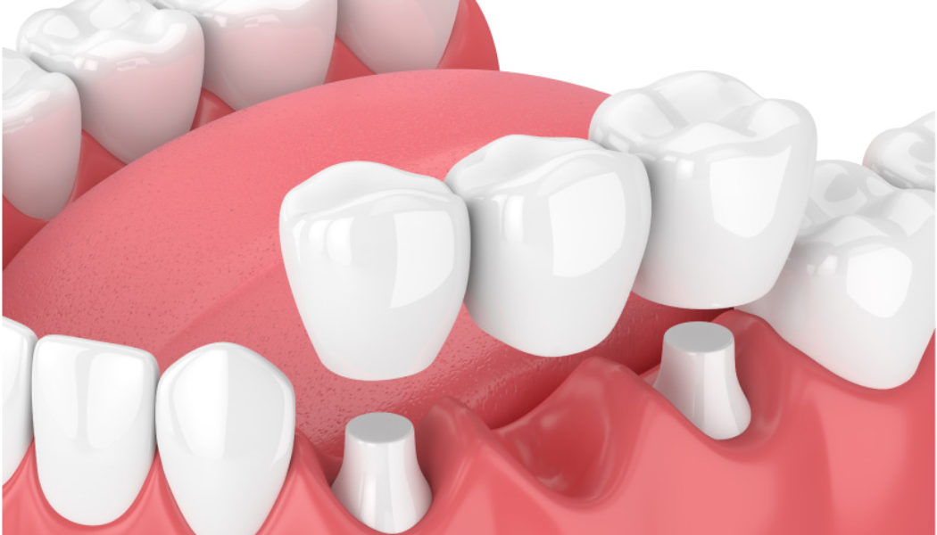 Dental Bridge Procedure Description