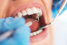 Root Canal Procedure Description