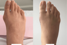 Bunion Surgery Procedure Description