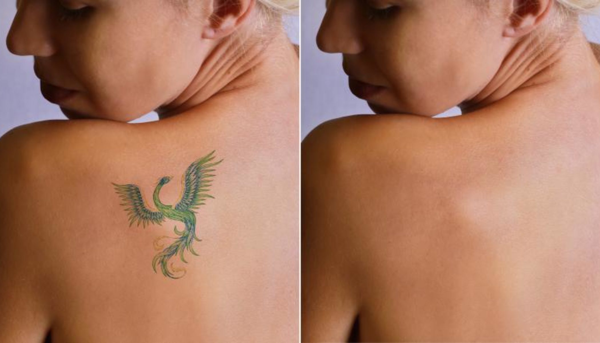 Laser Tattoo Removal Procedure Description | MyMediTravel Knowledge