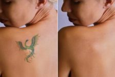 Laser Tattoo Removal Procedure Description