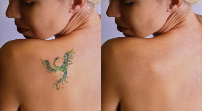 Laser Tattoo Removal Procedure Description