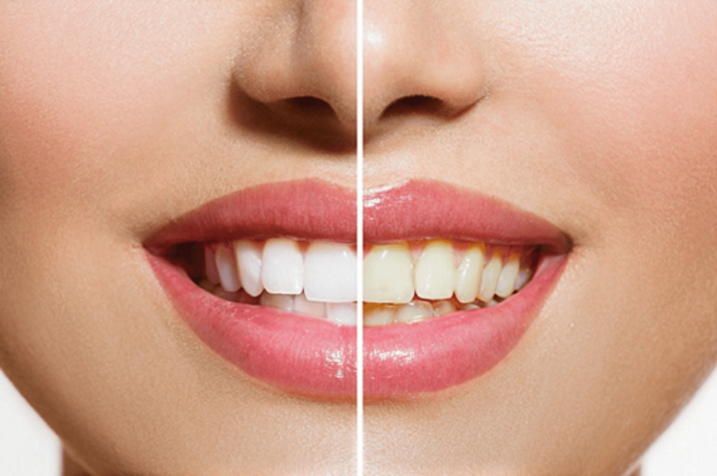 Teeth Whitening Procedure Description