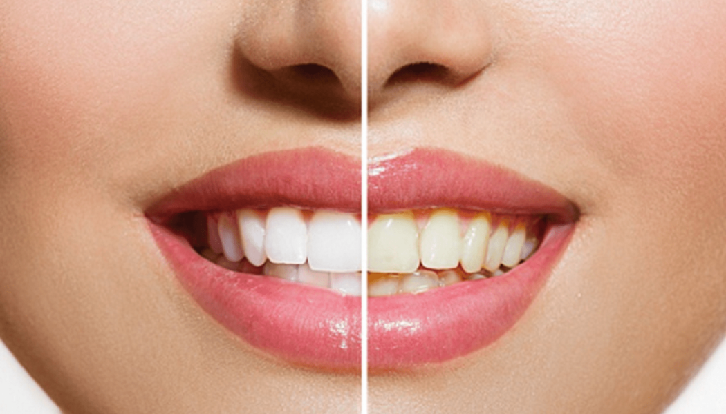 Teeth Whitening Procedure Description