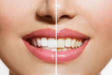 Teeth Whitening Procedure Description