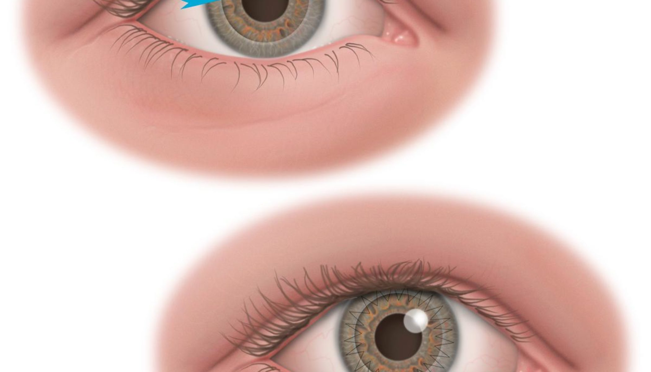 Cornea Transplant Procedure Description MyMediTravel Knowledge