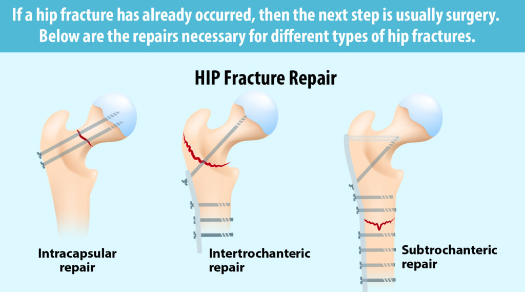 Hip Fracture Surgery Procedure Description Mymeditravel Knowledge