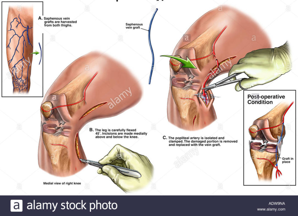 femoral-artery-bypass-surgery-procedure-description-mymeditravel